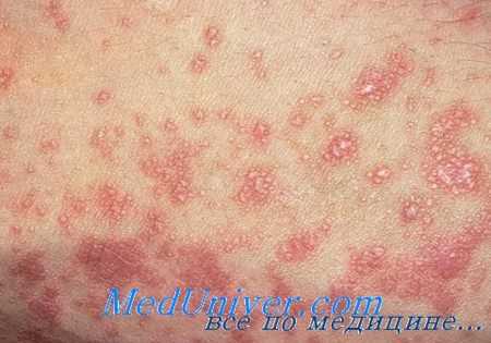 плоский лишай