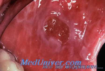 плоский лишай