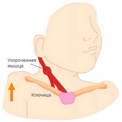 Спастическая кривошея