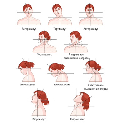 Типы дистонии