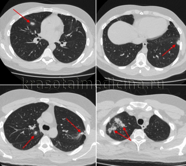 Туберкулез легких