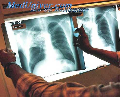 туберкулез пожилых