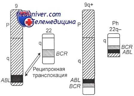 хромосомные аномалии хронического миелоидного лейкоза