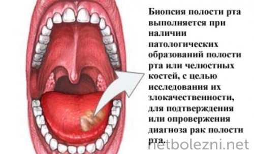 Биопсия полости рта