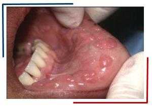 Очаговая гиперплазия