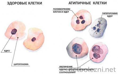 Клетки опухолевые атипичные