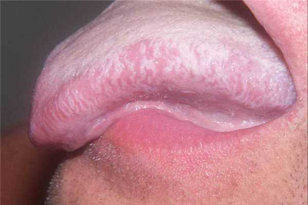 Лейкоплакия в области языка