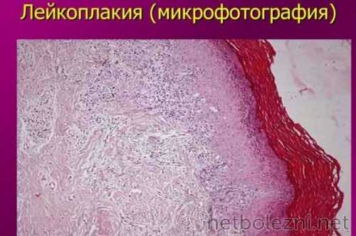 Микрофотография поражения слизистой