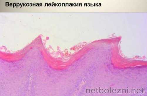 Веррукозная лейкоплакия языка