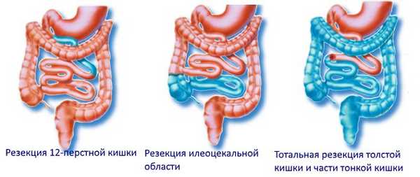 Хирургическое лечение осложнений болезни Крона