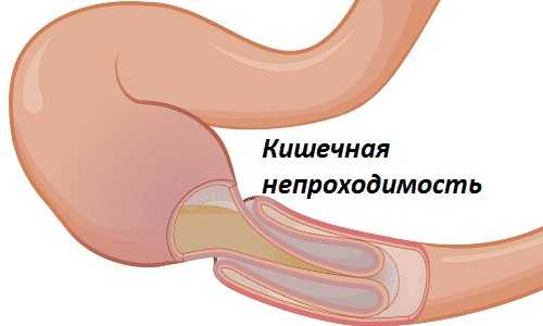 Кишечная непроходимость