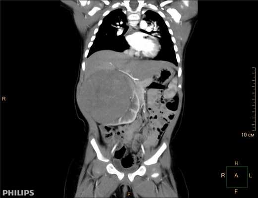 Нейробластома