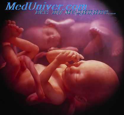 моноамниотическая двойня