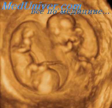 моноамниотические двойни