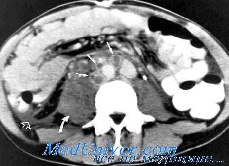 КТ забрюшинных лимфоузлов при лимфогранулематозе