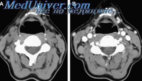 лимфогранулематоз