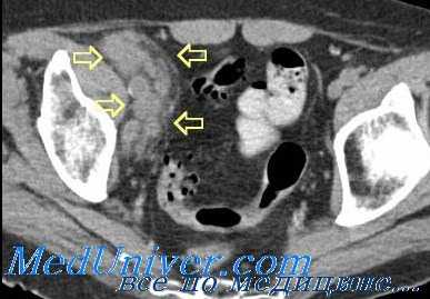 Тазовые лимфоузлы на компьютерной томограмме при болезни Ходжкина