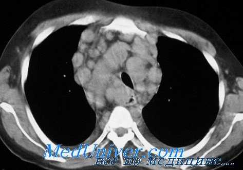 КТ органов грудной клетки при болезни Ходжкина