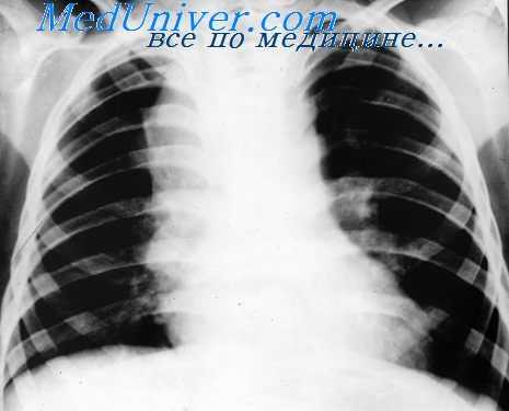 лимфогранулематоз