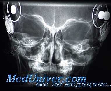 синустромбоз