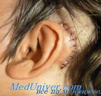 ээг при менингите