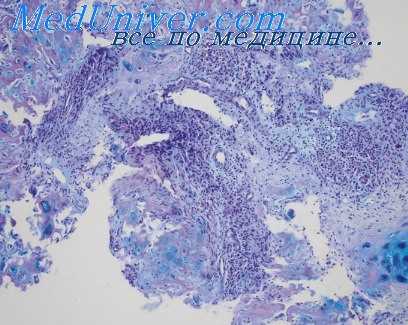 дерматит экзема