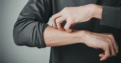 Экзема. Этиология и патогенез