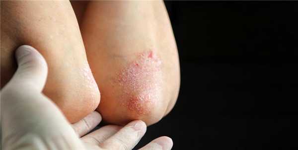 Дерматит и псориаз