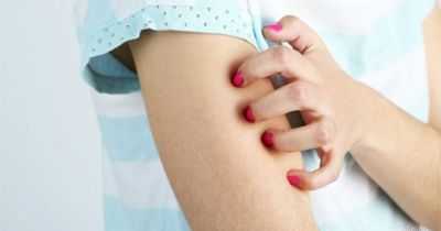 Экзема. Этиология и патогенез