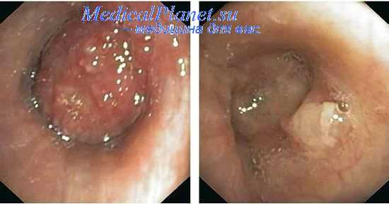 Бронхоскопия при раке легкого