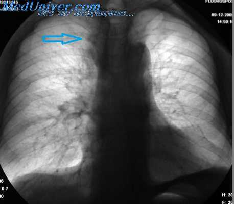 Эпидермальный рак легкого