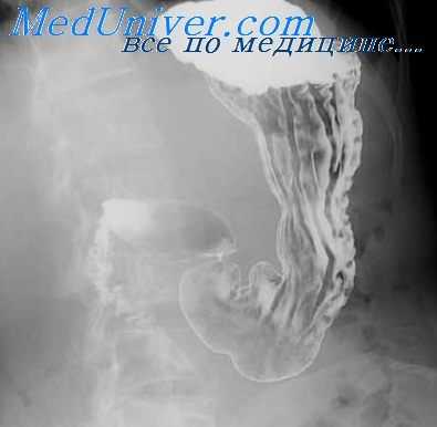 воспаление желудка