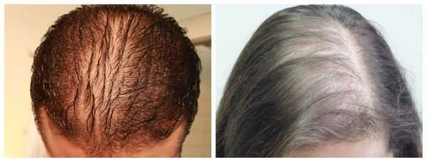 Диффузная алопеция