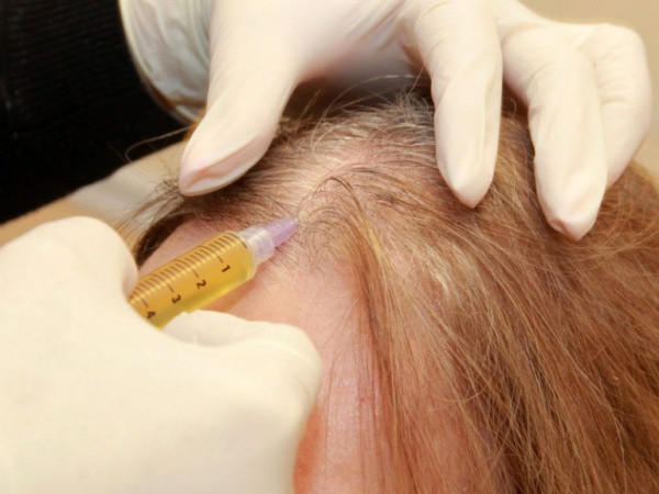 Плазмотерапия кожи головы