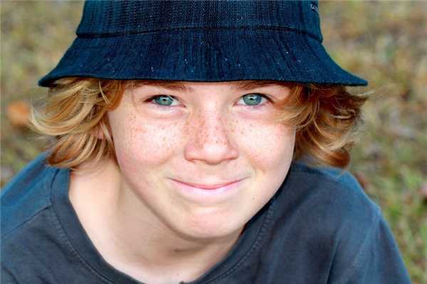 Локальная пигментация: веснушки, пятна у детей