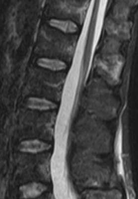 zhelatinoznaya-transformaciya