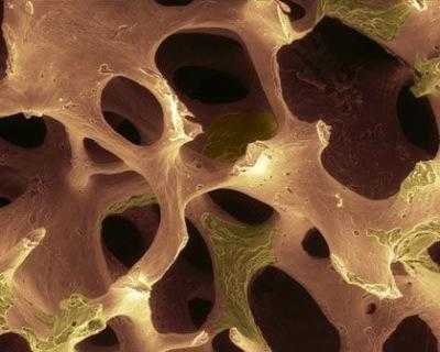 Пористость костной ткани - основной признак остеопороза на рентгене