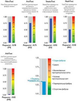 Степени выраженности жировой инфильтрации