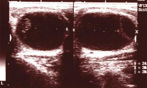 Эхограмма - посттравматическая киста щитовидной железы