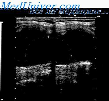 изменения щитовидной железы