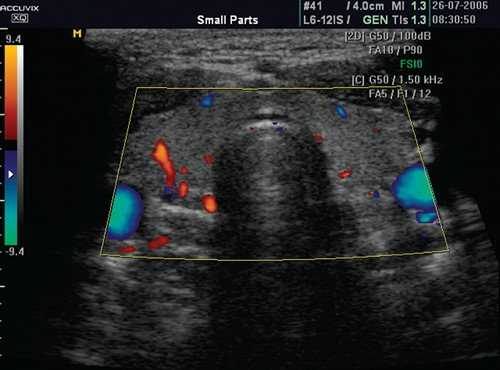 Эхограмма щитовидной железы при тиреоидите с тиреотоксикозом (паренхима гомогенно умеренно уплотнена, переход от перешейка к долям сглажен за счет отека, кровоток усилен)