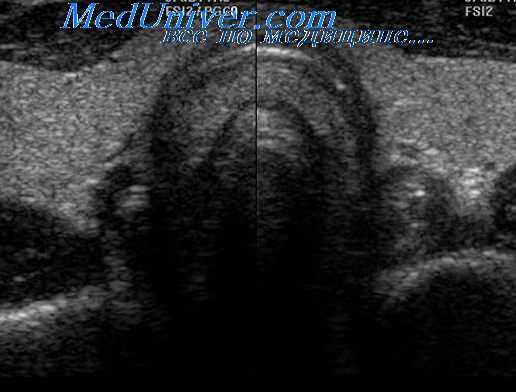 изменения щитовидной железы