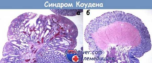 Синдром Коудена