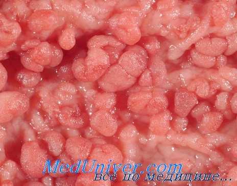 семейный полипоз кишечника