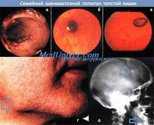 Семейный аденоматозный полипоз толстой кишки