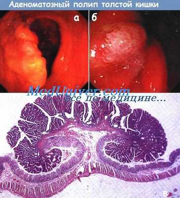 Аденоматозный полип толстой кишки