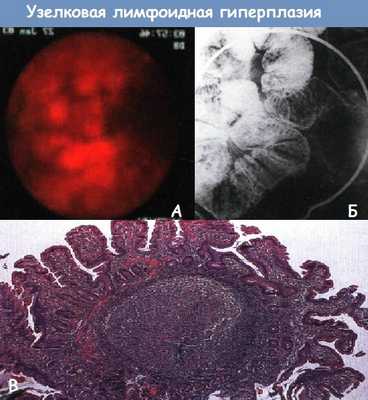 Узелковая лимфоидная гиперплазия кишечника