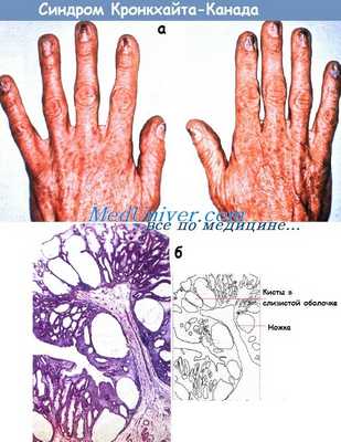 Синдром Кронкхайта-Канада