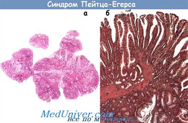 Синдром Пейтца—Егерса