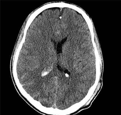 Диффузное аксональное повреждение, Черепно-мозговая травма, ДТП